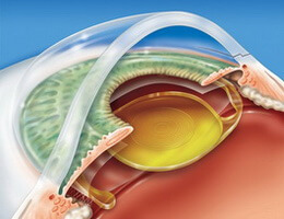 Как изменилась операция по удалению катаракты за последние 10 лет?