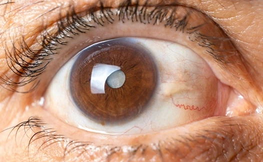 Хориоретинит: причины, симптомы, диагностика и лечение