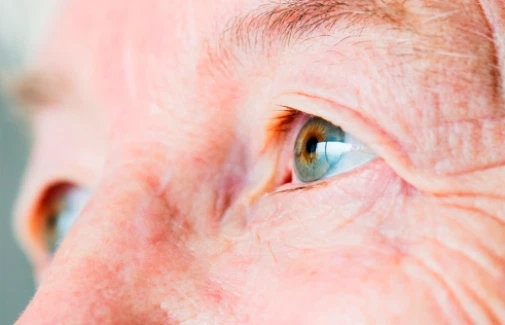 Ядерная катаракта