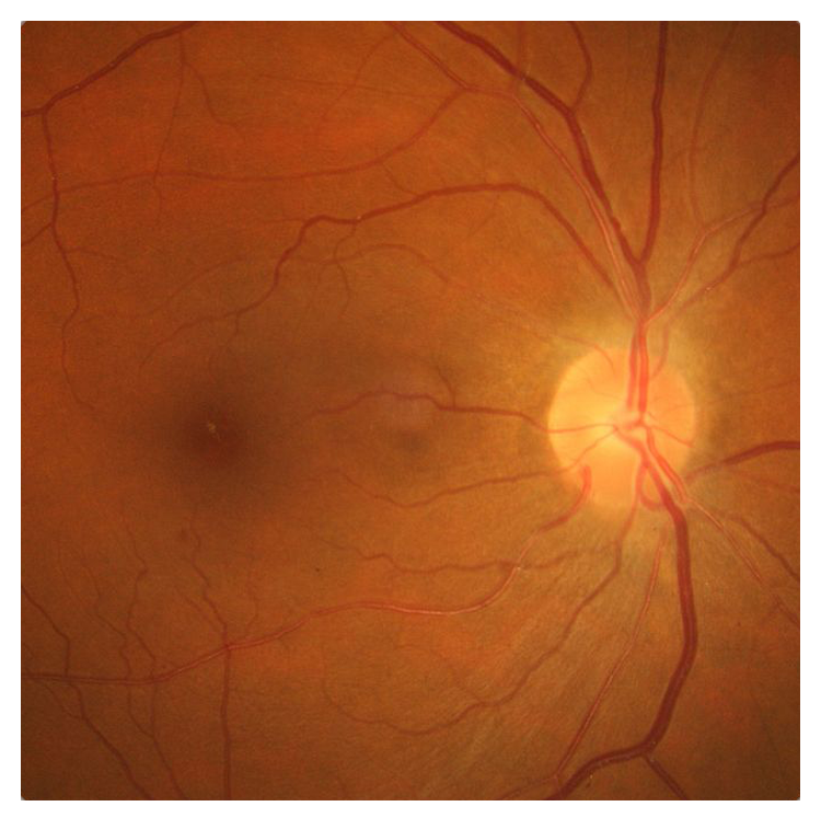 здоровая сетчатка