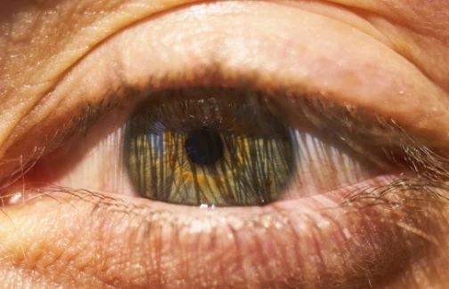 Дермоидная киста на веке: причины, симптомы, диагностика и лечение
