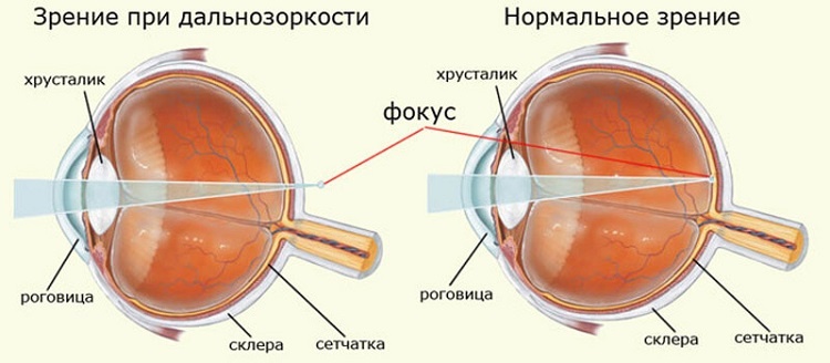 Степени дальнозоркости