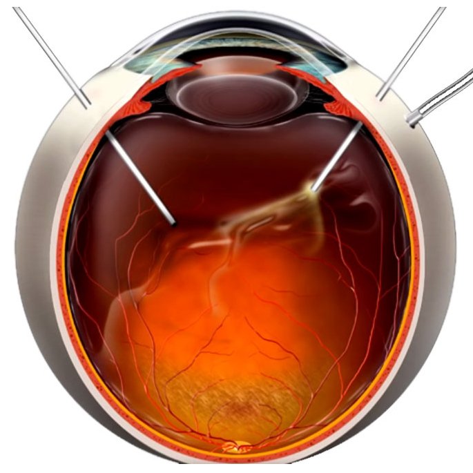 Витрэктомия Витрэктомия