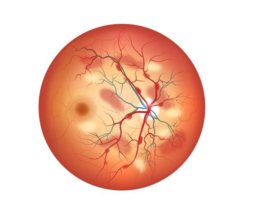 Фоновая ретинопатия и ретинальные сосудистые изменения глаза