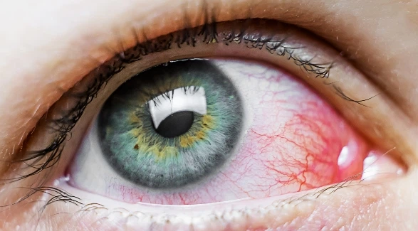 Инфекционные заболевания глаз