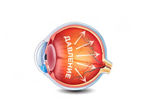 Высокое глазное давление — причины, симптомы, лечение
