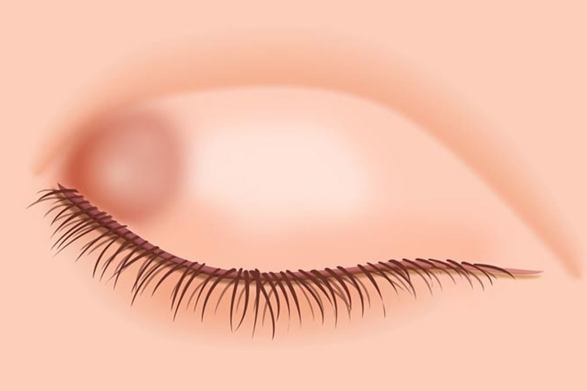 Халязион на веке. Причины и лечение