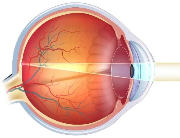 Эмметропия глаза