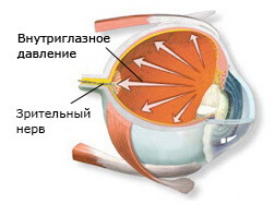 Глаукома Глаукома