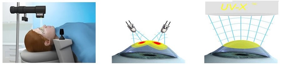 Воздействие лампой Зайлера на роговицу Воздействие лампой Зайлера на роговицу