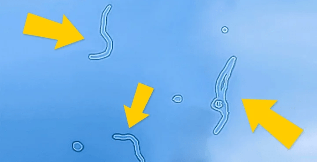 Мушки перед глазами - причины появления