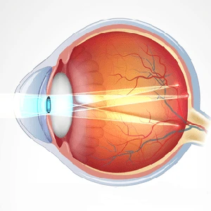астигматизм что такое астигматизм - схема глаза