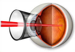 Периферическая профилактическая лазерная коагуляция сетчатки