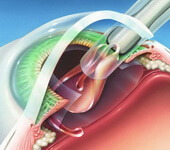 Лечение катаракты