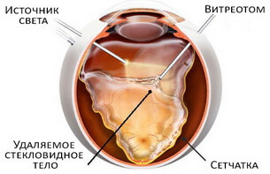 Витрэктомия