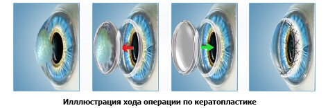Иллюстрация хода операции по кератопластике