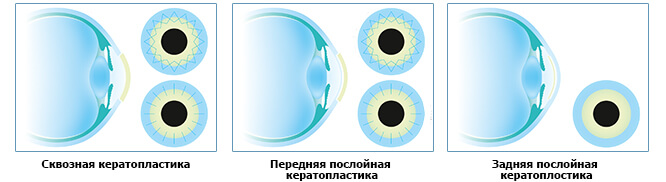 Виды кератопластики