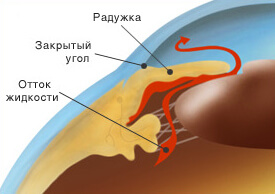 Закрытоугольная глаукома